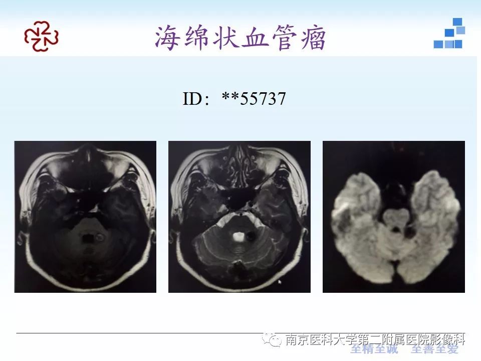 影像PPT - 【PPT】颅内短T1信号的影像诊断-16
