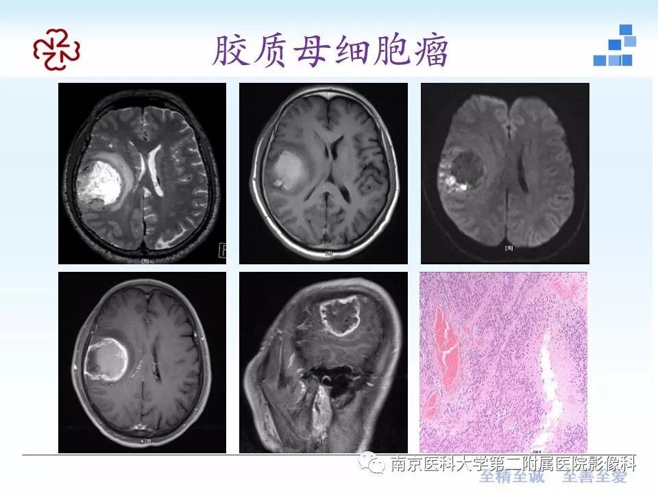 影像PPT - 【PPT】颅内短T1信号的影像诊断-19