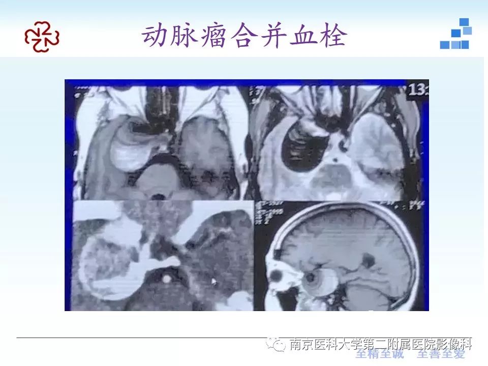 影像PPT - 【PPT】颅内短T1信号的影像诊断-23