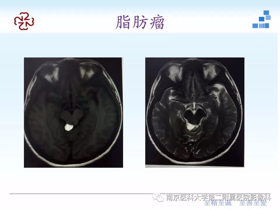 影像PPT - 【PPT】颅内短T1信号的影像诊断-25