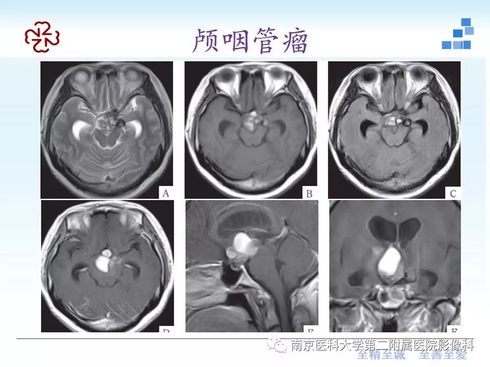 影像PPT - 【PPT】颅内短T1信号的影像诊断-31