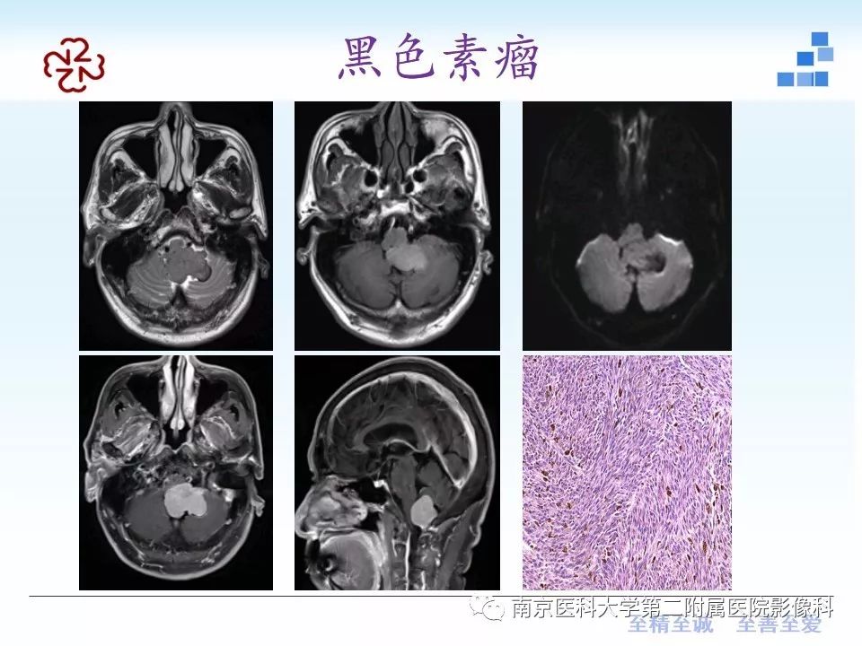 影像PPT - 【PPT】颅内短T1信号的影像诊断-33