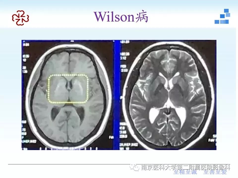 影像PPT - 【PPT】颅内短T1信号的影像诊断-35