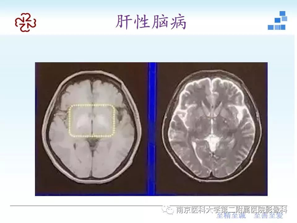 影像PPT - 【PPT】颅内短T1信号的影像诊断-36