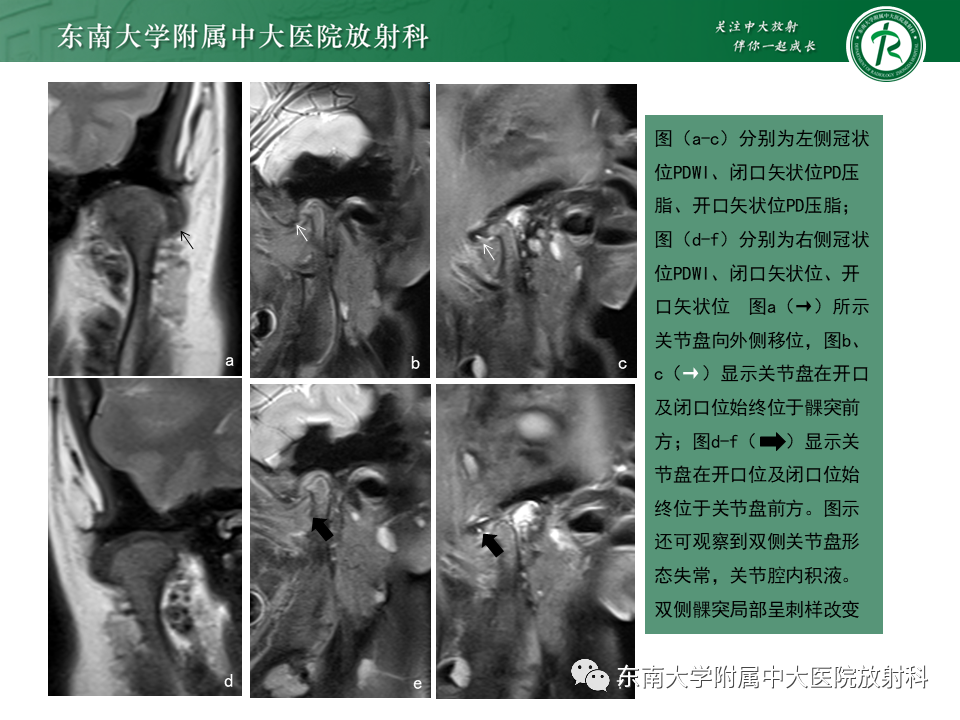 影像PPT - 【PPT】颞下颌关节紊乱病MR表现-2