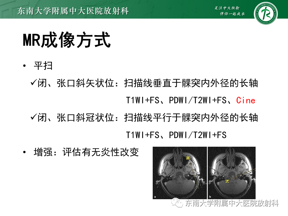 影像PPT - 【PPT】颞下颌关节紊乱病MR表现-14