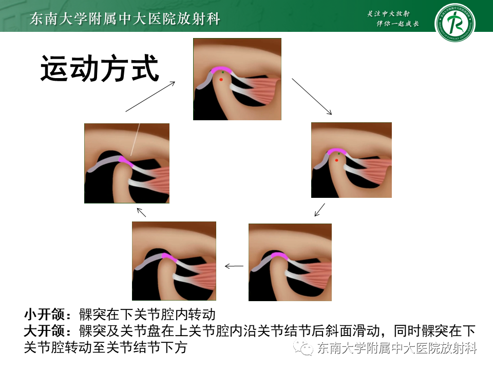 影像PPT - 【PPT】颞下颌关节紊乱病MR表现-13