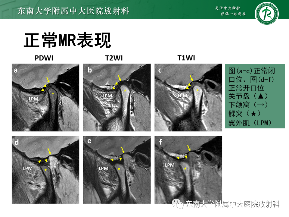 影像PPT - 【PPT】颞下颌关节紊乱病MR表现-17