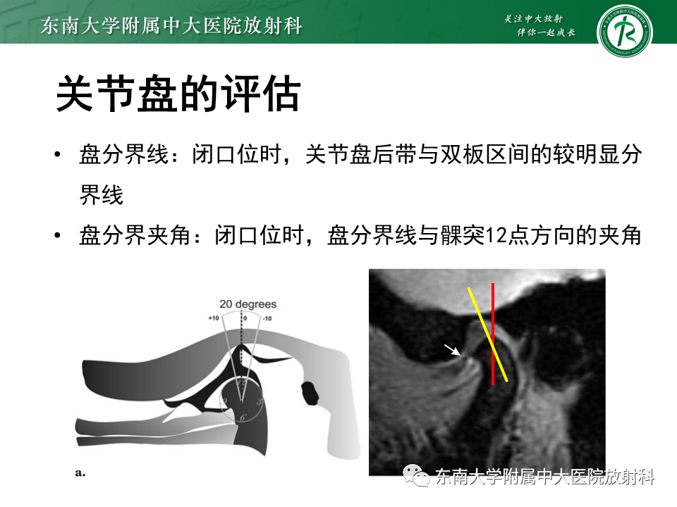 影像PPT - 【PPT】颞下颌关节紊乱病MR表现-21