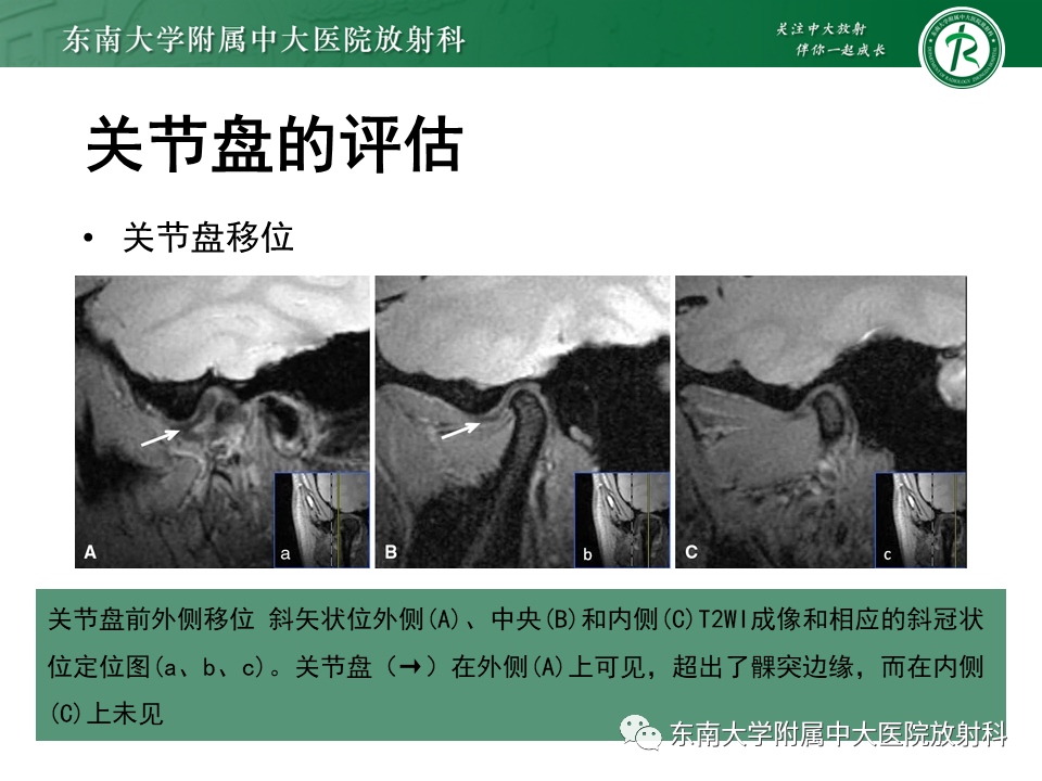 影像PPT - 【PPT】颞下颌关节紊乱病MR表现-22