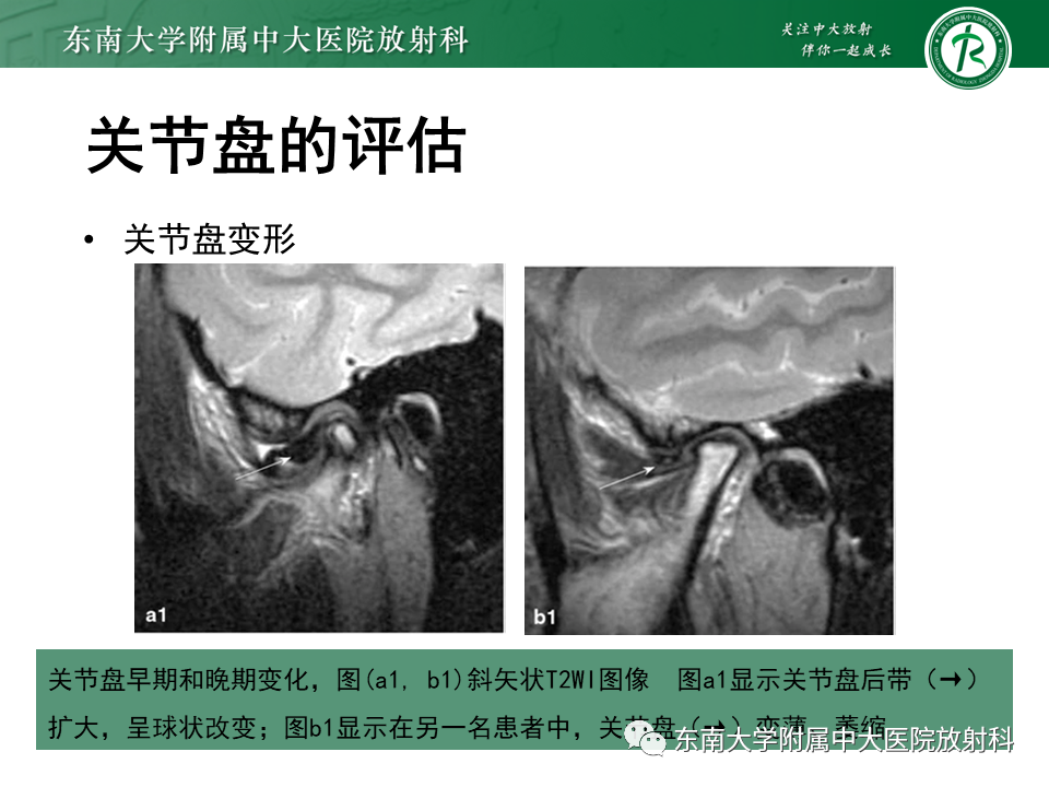 影像PPT - 【PPT】颞下颌关节紊乱病MR表现-23