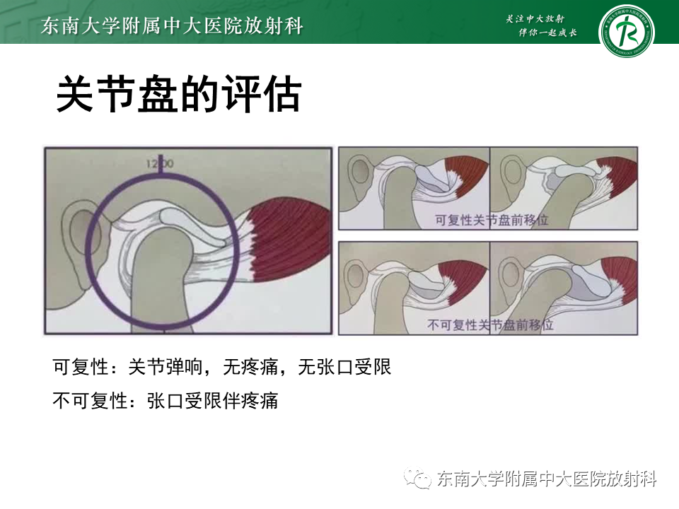 影像PPT - 【PPT】颞下颌关节紊乱病MR表现-20