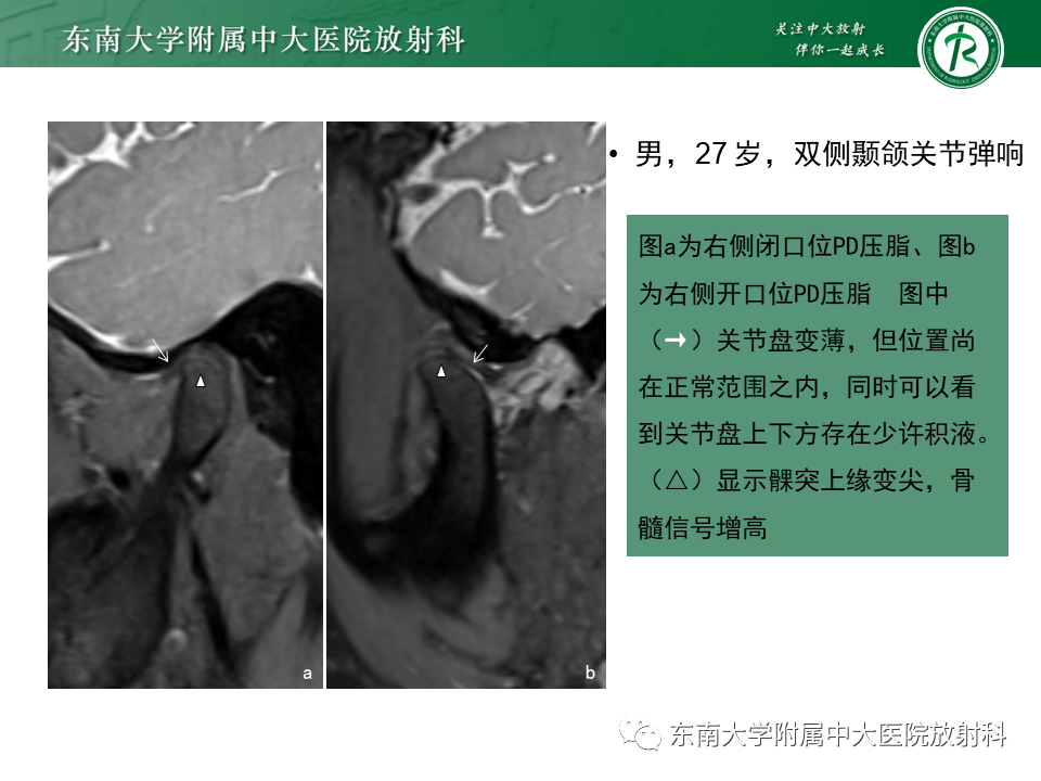 影像PPT - 【PPT】颞下颌关节紊乱病MR表现-24