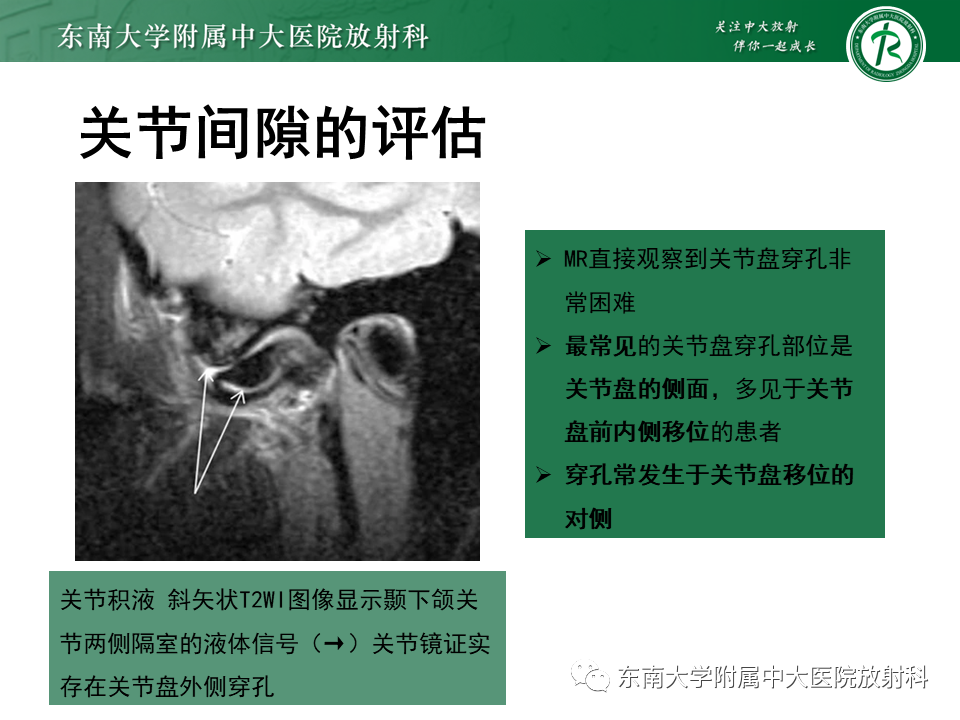 影像PPT - 【PPT】颞下颌关节紊乱病MR表现-26