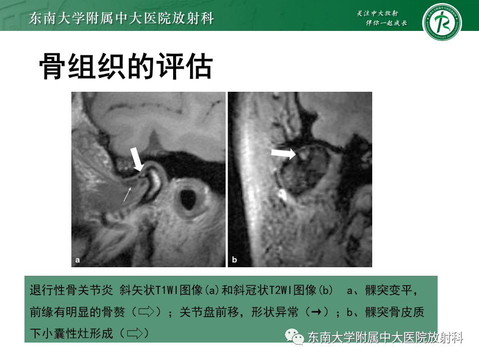 影像PPT - 【PPT】颞下颌关节紊乱病MR表现-28