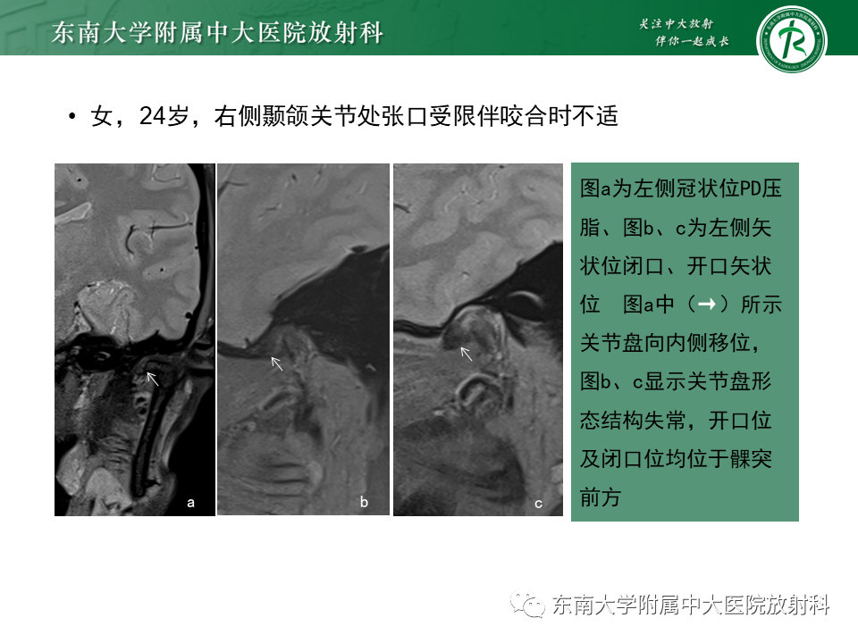 影像PPT - 【PPT】颞下颌关节紊乱病MR表现-29