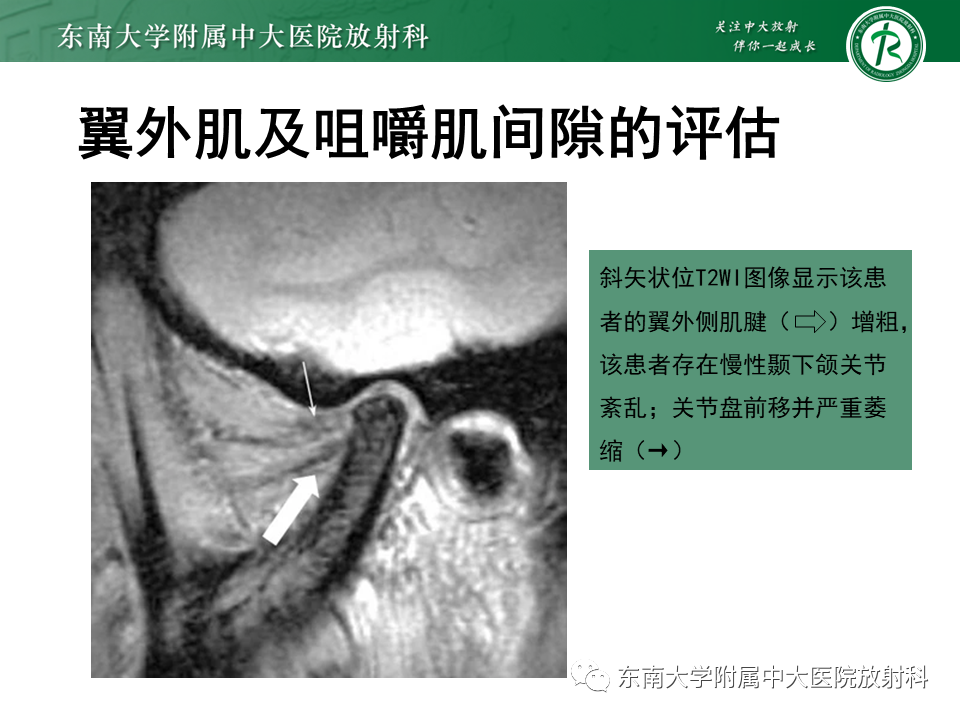 影像PPT - 【PPT】颞下颌关节紊乱病MR表现-31
