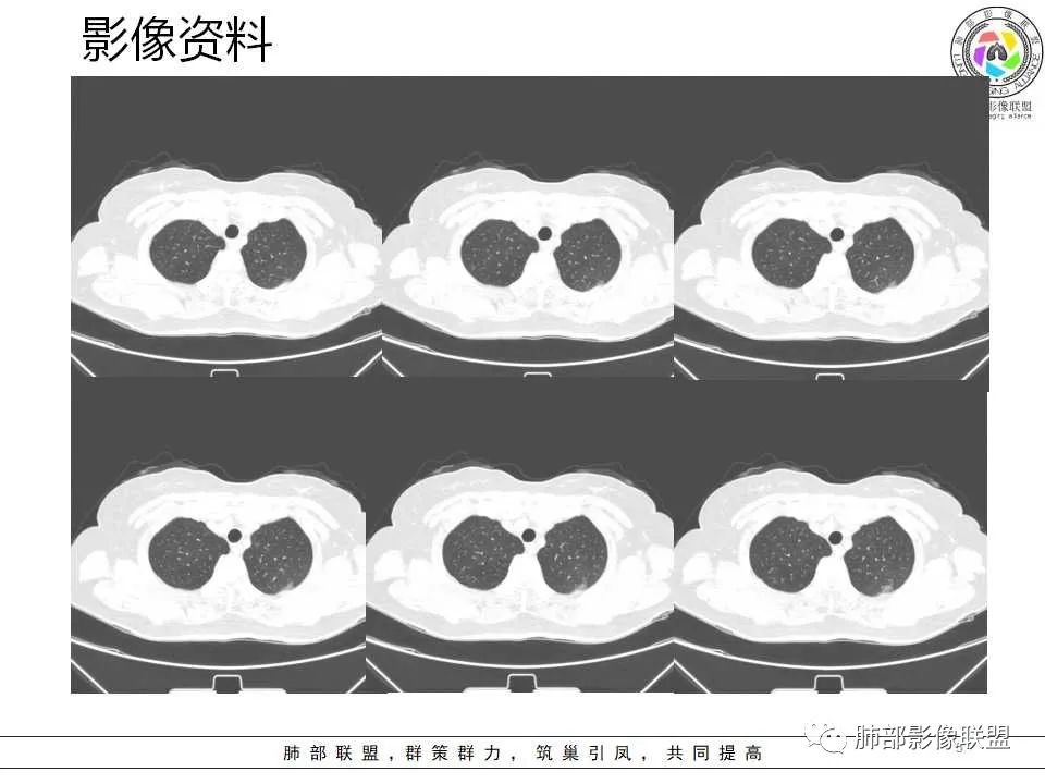 影像PPT - 【病例】从生物特性分析影像识隐球-5 影像PPT - 【病例】从生物特性分析影像识隐球-5