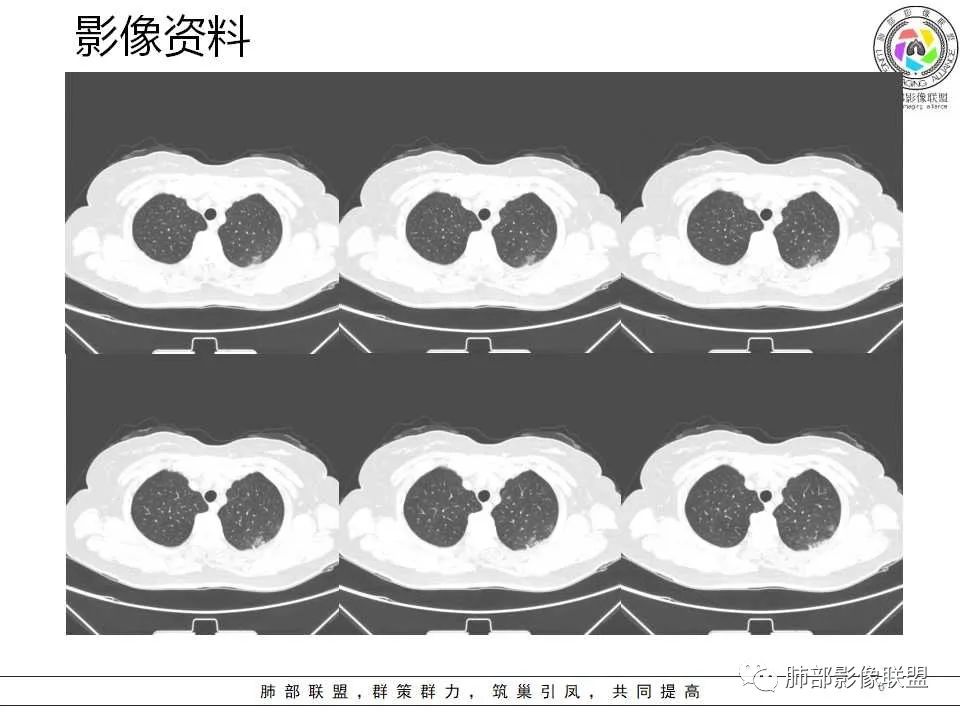 影像PPT - 【病例】从生物特性分析影像识隐球-6 影像PPT - 【病例】从生物特性分析影像识隐球-6