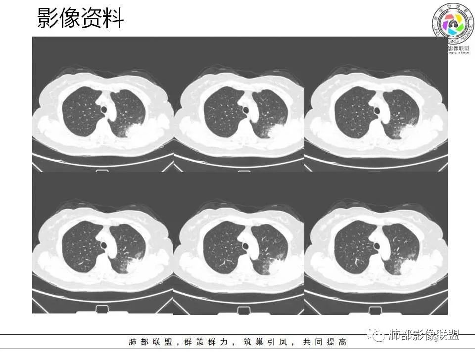 影像PPT - 【病例】从生物特性分析影像识隐球-9 影像PPT - 【病例】从生物特性分析影像识隐球-9