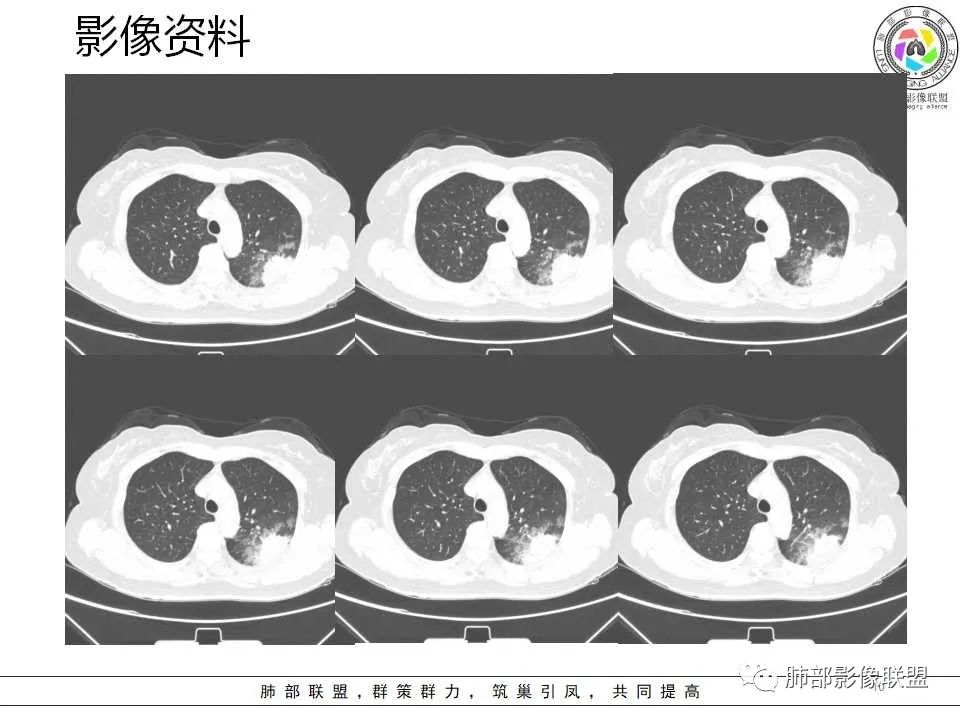 影像PPT - 【病例】从生物特性分析影像识隐球-10 影像PPT - 【病例】从生物特性分析影像识隐球-10