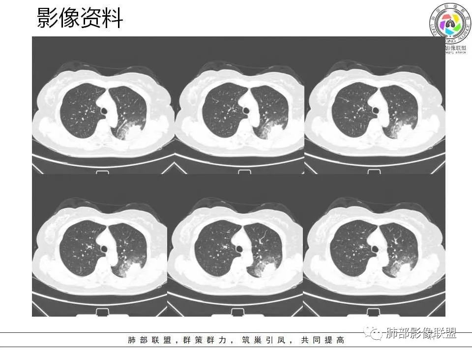 影像PPT - 【病例】从生物特性分析影像识隐球-11 影像PPT - 【病例】从生物特性分析影像识隐球-11