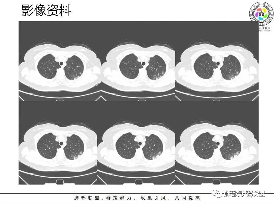 影像PPT - 【病例】从生物特性分析影像识隐球-7 影像PPT - 【病例】从生物特性分析影像识隐球-7