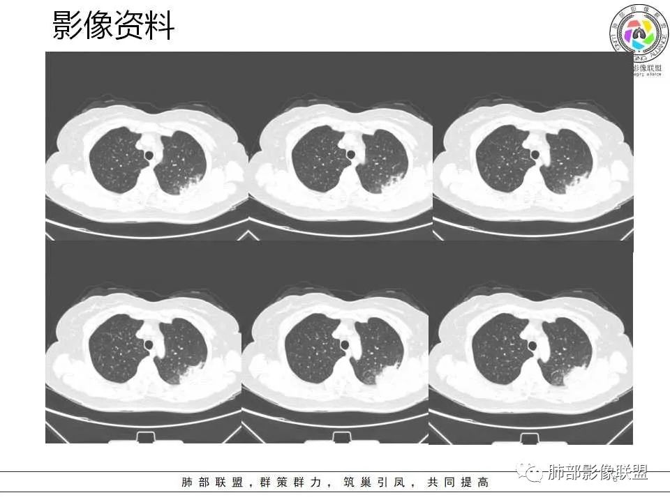 影像PPT - 【病例】从生物特性分析影像识隐球-8 影像PPT - 【病例】从生物特性分析影像识隐球-8