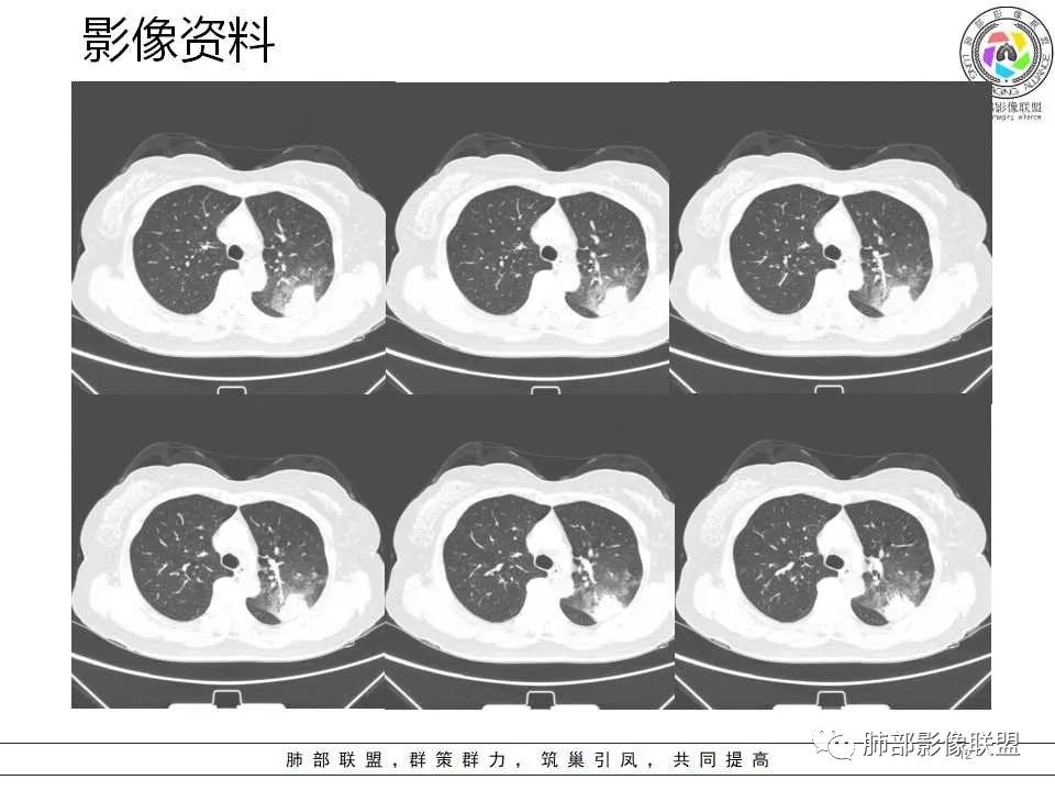 影像PPT - 【病例】从生物特性分析影像识隐球-12 影像PPT - 【病例】从生物特性分析影像识隐球-12