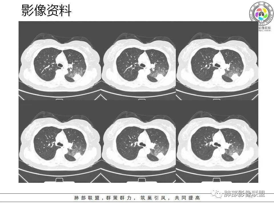 影像PPT - 【病例】从生物特性分析影像识隐球-13 影像PPT - 【病例】从生物特性分析影像识隐球-13