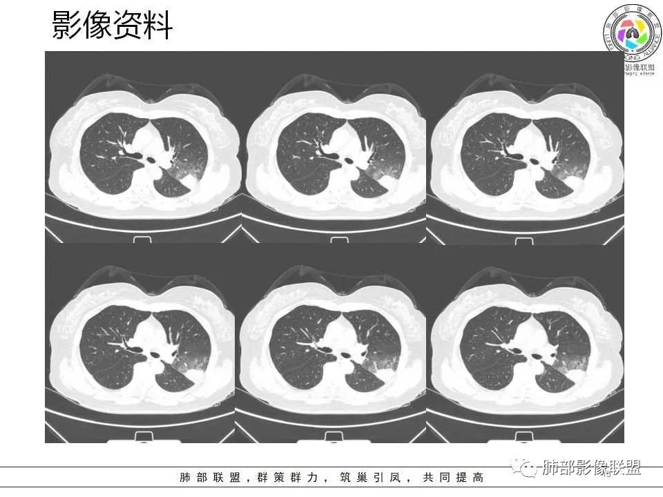 影像PPT - 【病例】从生物特性分析影像识隐球-15 影像PPT - 【病例】从生物特性分析影像识隐球-15