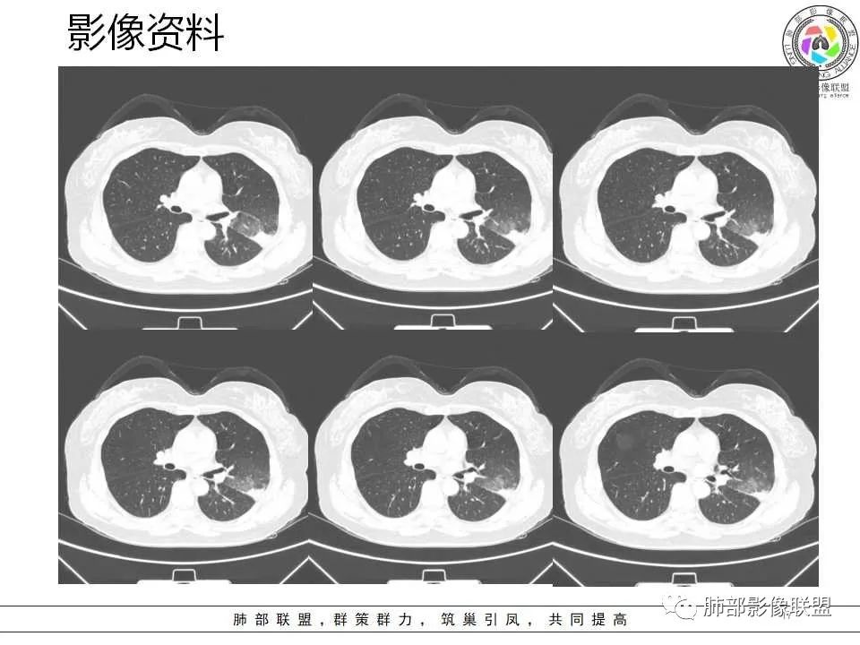 影像PPT - 【病例】从生物特性分析影像识隐球-17 影像PPT - 【病例】从生物特性分析影像识隐球-17