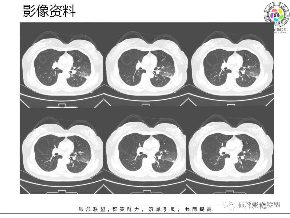 影像PPT - 【病例】从生物特性分析影像识隐球-18 影像PPT - 【病例】从生物特性分析影像识隐球-18