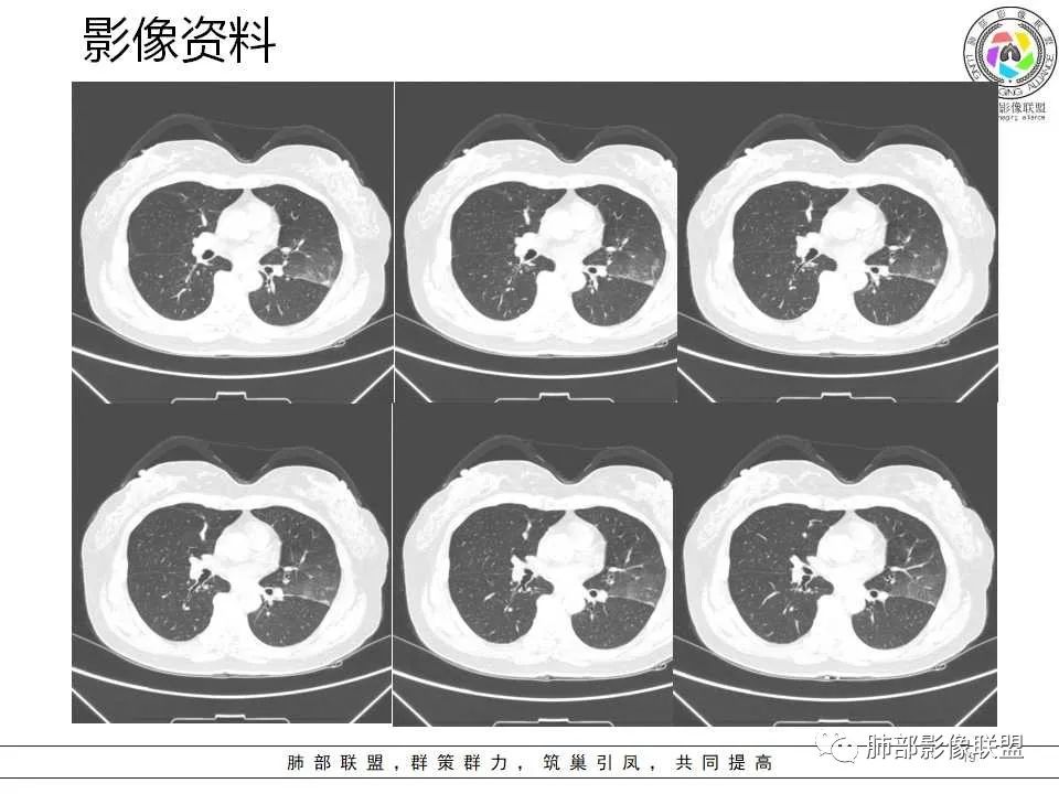 影像PPT - 【病例】从生物特性分析影像识隐球-19 影像PPT - 【病例】从生物特性分析影像识隐球-19