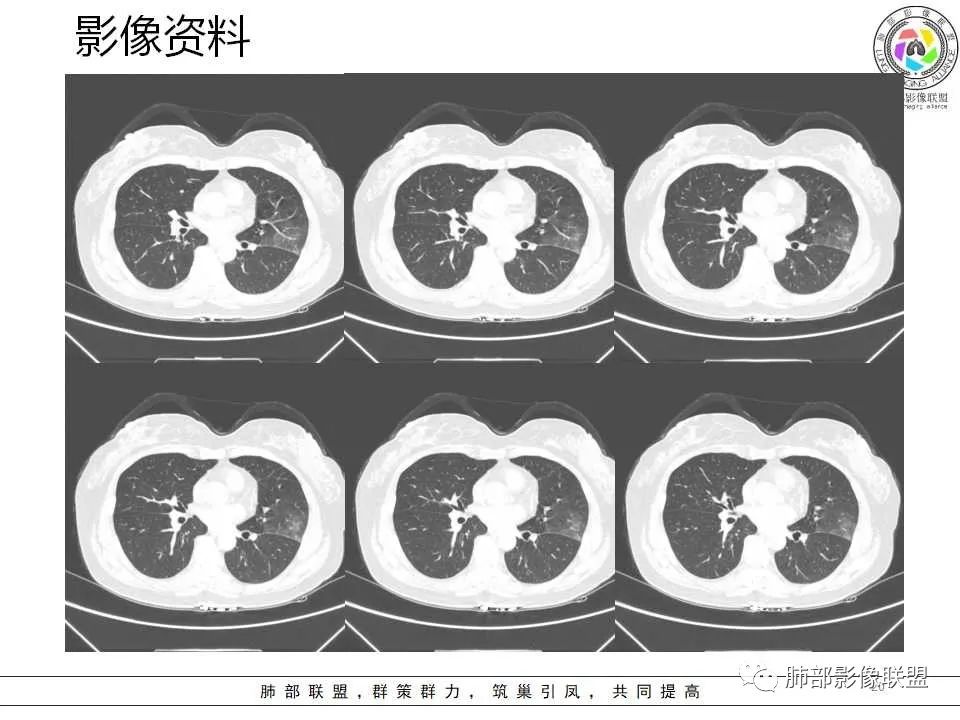 影像PPT - 【病例】从生物特性分析影像识隐球-20 影像PPT - 【病例】从生物特性分析影像识隐球-20