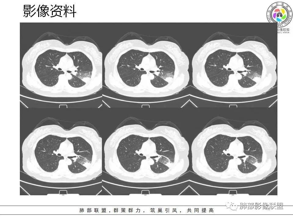 影像PPT - 【病例】从生物特性分析影像识隐球-16 影像PPT - 【病例】从生物特性分析影像识隐球-16