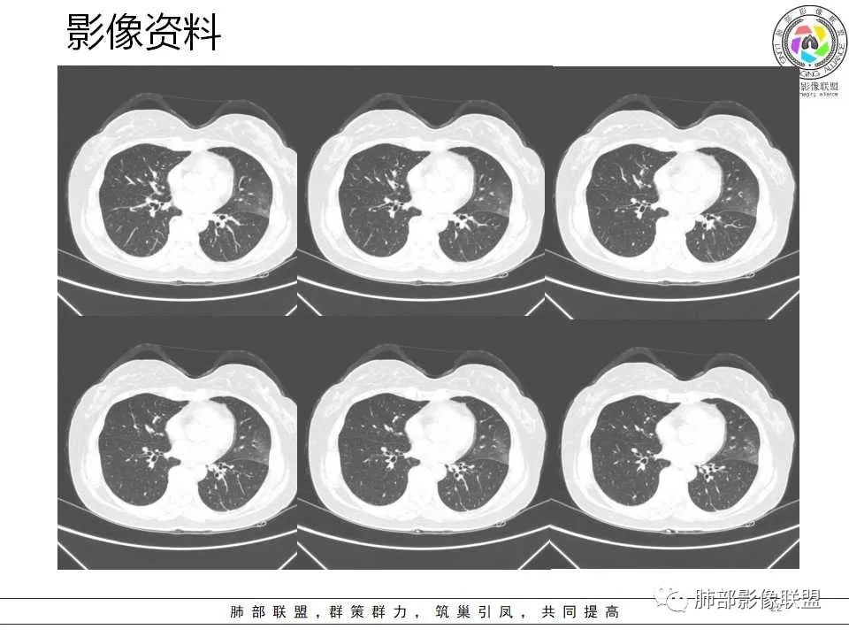 影像PPT - 【病例】从生物特性分析影像识隐球-22 影像PPT - 【病例】从生物特性分析影像识隐球-22