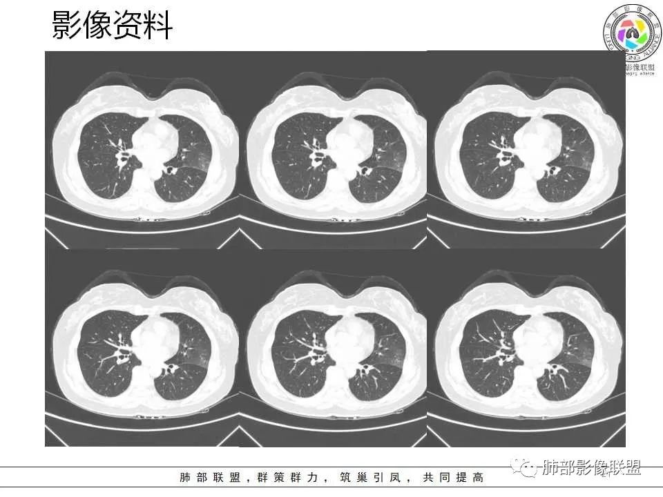 影像PPT - 【病例】从生物特性分析影像识隐球-21 影像PPT - 【病例】从生物特性分析影像识隐球-21