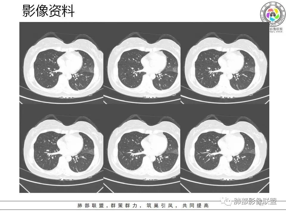 影像PPT - 【病例】从生物特性分析影像识隐球-23 影像PPT - 【病例】从生物特性分析影像识隐球-23