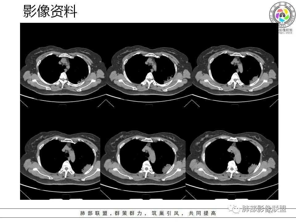 影像PPT - 【病例】从生物特性分析影像识隐球-24 影像PPT - 【病例】从生物特性分析影像识隐球-24