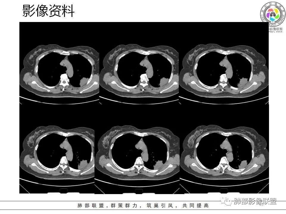 影像PPT - 【病例】从生物特性分析影像识隐球-25 影像PPT - 【病例】从生物特性分析影像识隐球-25