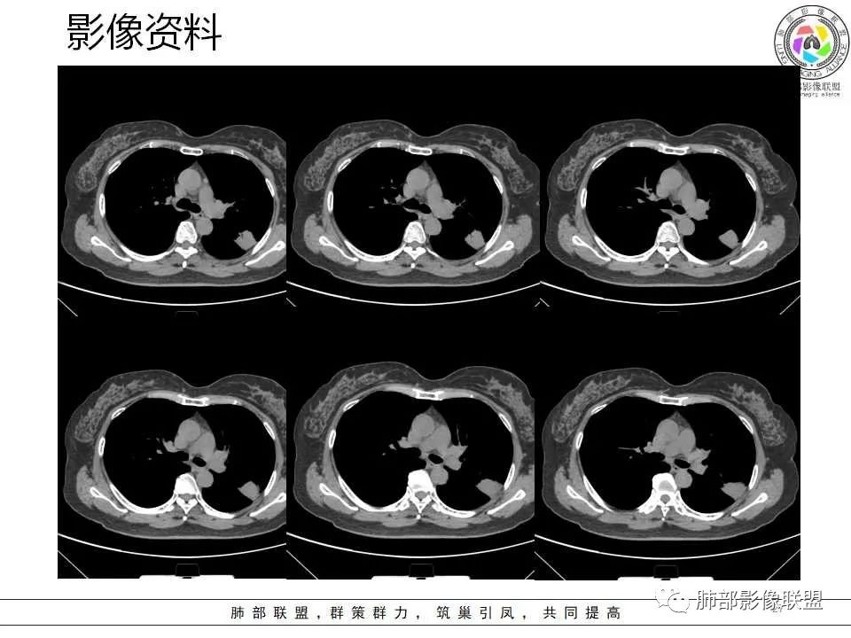 影像PPT - 【病例】从生物特性分析影像识隐球-27 影像PPT - 【病例】从生物特性分析影像识隐球-27