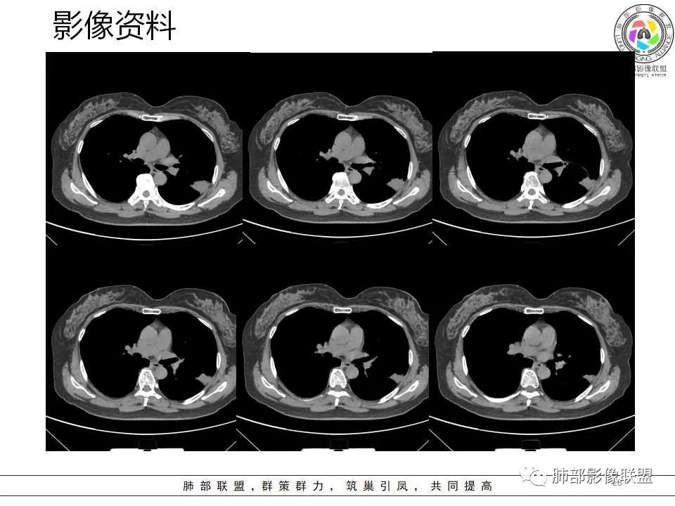 影像PPT - 【病例】从生物特性分析影像识隐球-28 影像PPT - 【病例】从生物特性分析影像识隐球-28