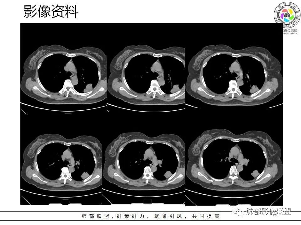 影像PPT - 【病例】从生物特性分析影像识隐球-26 影像PPT - 【病例】从生物特性分析影像识隐球-26