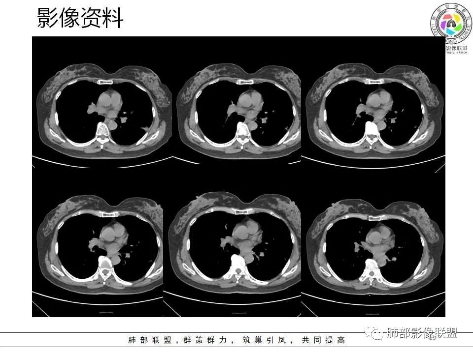 影像PPT - 【病例】从生物特性分析影像识隐球-29 影像PPT - 【病例】从生物特性分析影像识隐球-29