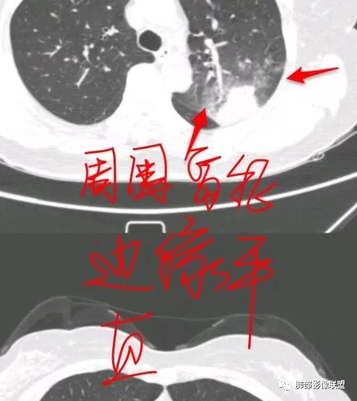 影像PPT - 【病例】从生物特性分析影像识隐球-34 影像PPT - 【病例】从生物特性分析影像识隐球-34