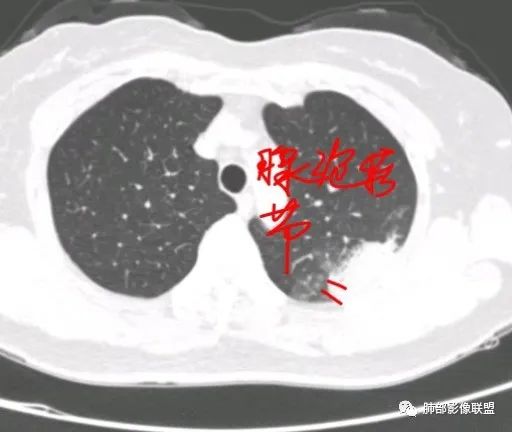 影像PPT - 【病例】从生物特性分析影像识隐球-33 影像PPT - 【病例】从生物特性分析影像识隐球-33