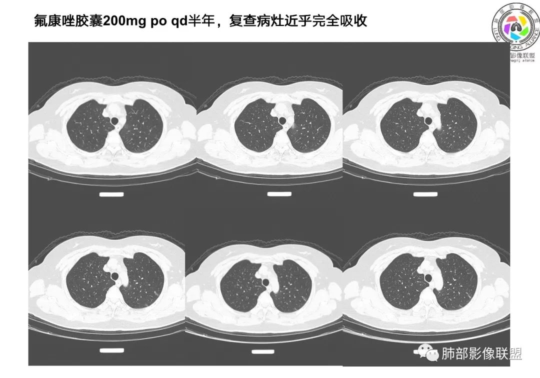 影像PPT - 【病例】从生物特性分析影像识隐球-40