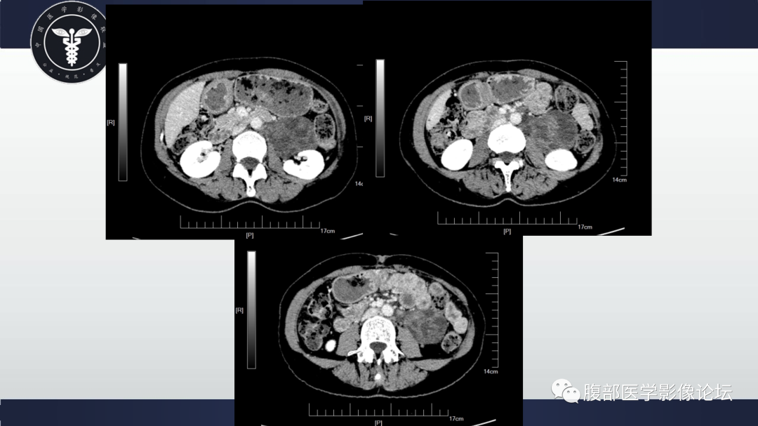 影像PPT - 【病例】腹膜后淋巴管肌瘤病1例CT影像-6 影像PPT - 【病例】腹膜后淋巴管肌瘤病1例CT影像-6