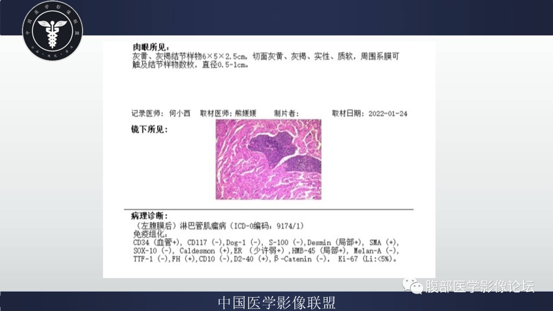 影像PPT - 【病例】腹膜后淋巴管肌瘤病1例CT影像-7 影像PPT - 【病例】腹膜后淋巴管肌瘤病1例CT影像-7